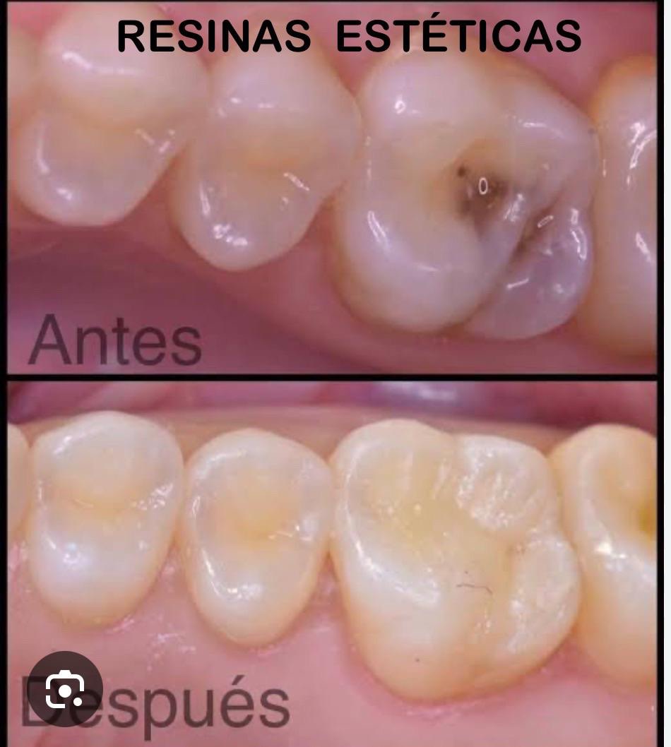 Servicio de resinas estéticas